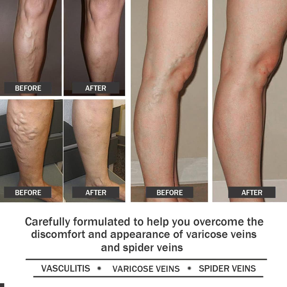 Varicose Veins Patches Dredge Vein Smoothing Varicose Veins Reduce Swelling Relieve Pain - Image 6