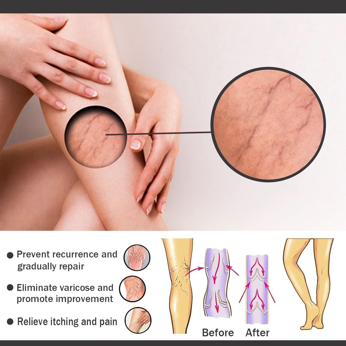 Varicose Veins Patches Dredge Vein Smoothing Varicose Veins Reduce Swelling Relieve Pain - Image 5